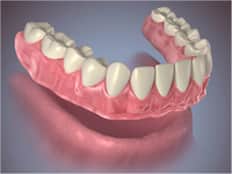 שיניים תותבות מלאות, קונבנציונליות או מיידיות